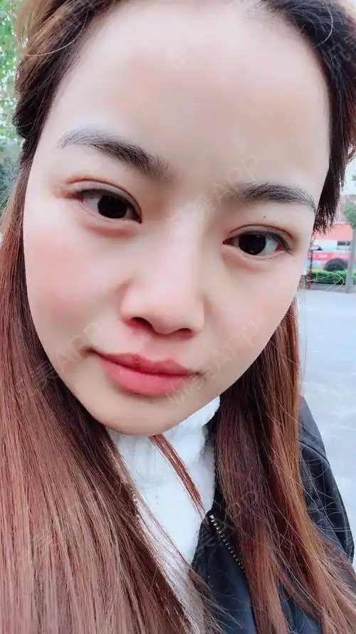 全切双眼皮术后9天_双眼皮术后9天_眼部整形术后9天_gowithme分享图片