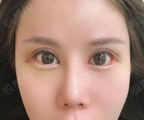 全切双眼皮术后7天_双眼皮术后7天_眼部整形术后7天_4iilw分享图片3