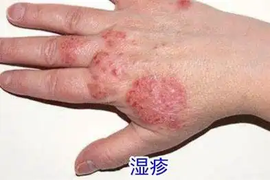 湿疹的图片