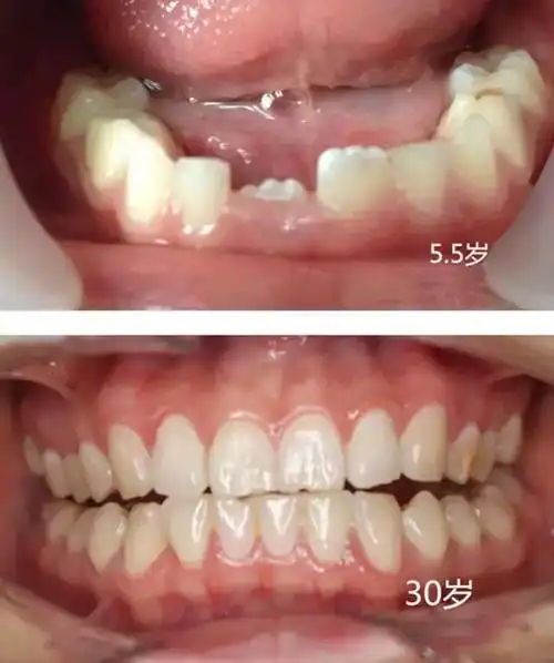 孩子出现了双排牙该不该拔