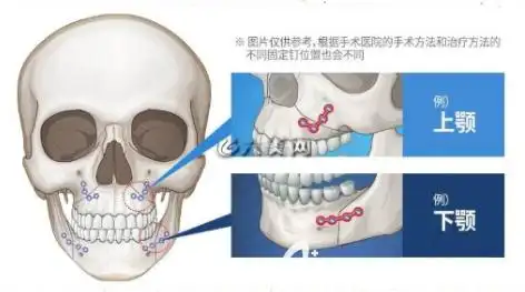 磨骨的钛钉一定要取出来吗