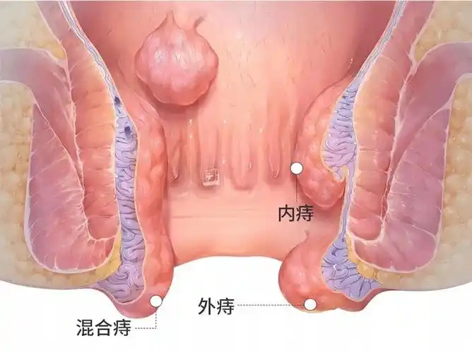 痔疮前期症状图片_有来医生