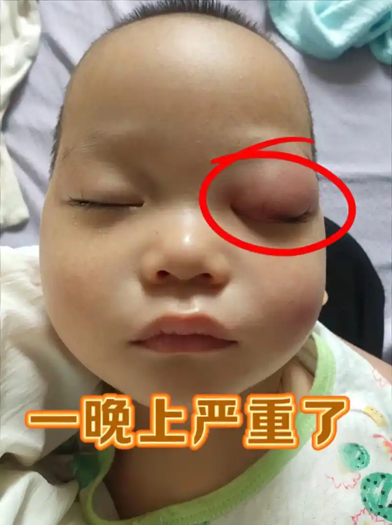 第二天早上眼睛肿的只能咪成一条缝,因为知道是蚊子咬的,所以