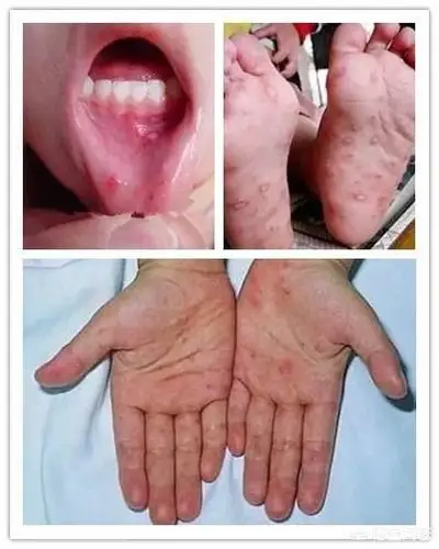 宣传手足口,健康你我他——克井小博士幼儿园手足口病宣传篇