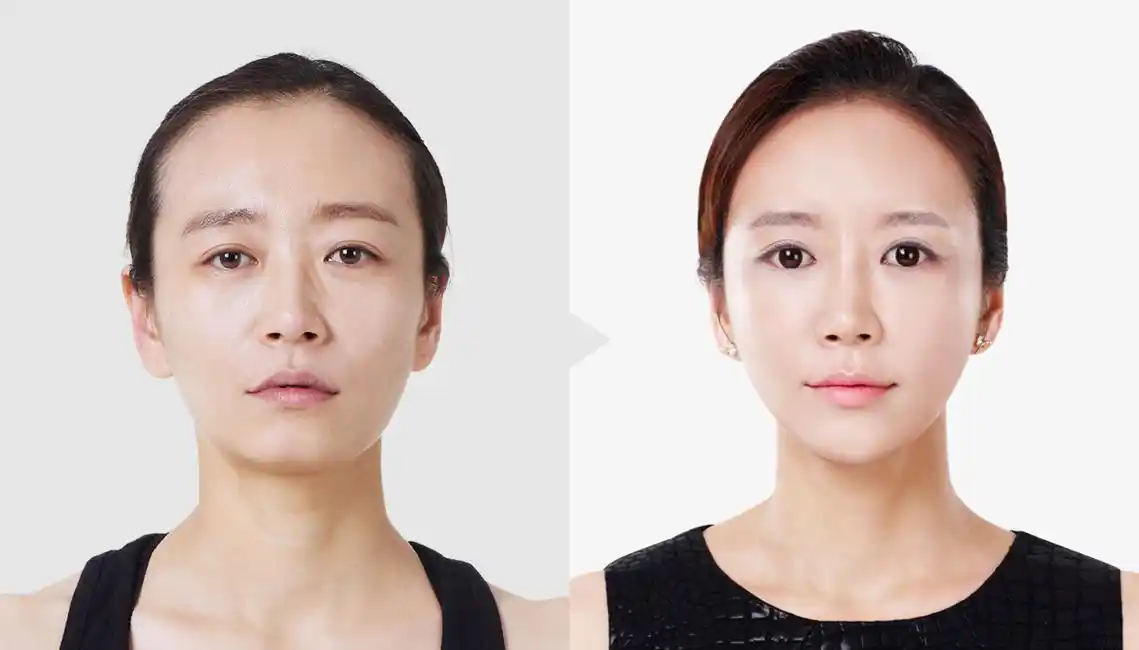 解决面部凹陷问题,全脸脂肪填充需要多少钱一次?有没有后遗症