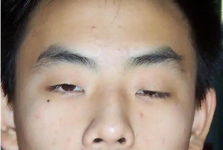 眼科重症肌无力