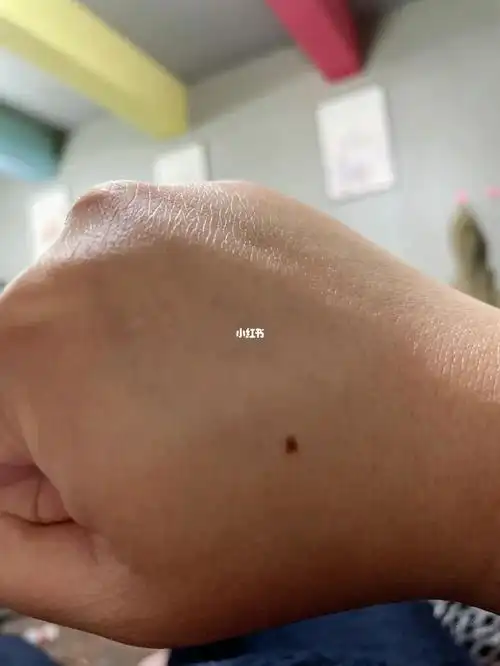 左手右手各长一个痣