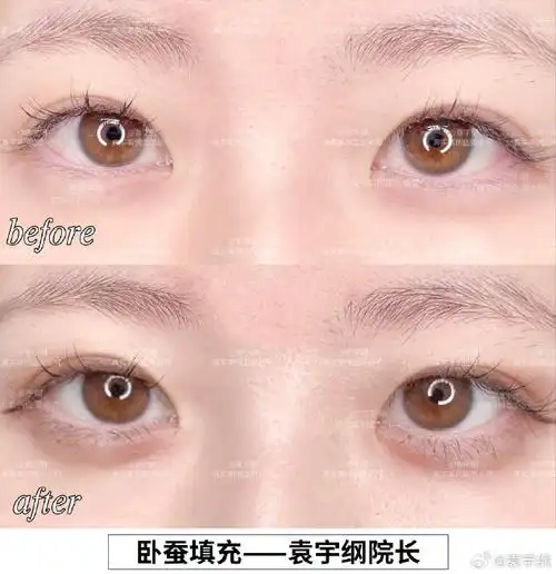 卧蚕##玻尿酸填充