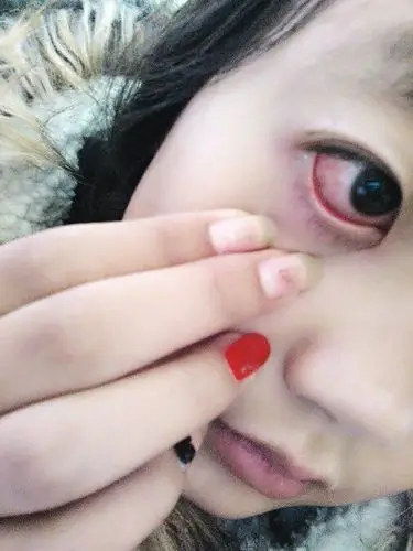 眼睛感染了,怎么办啊,疼着呢,烧的疼,还特别红