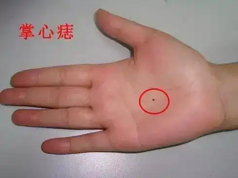 面相中的这些痣招财又好运,最好不要点