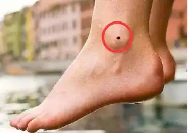 脚侧面脚踝有痣代表什么