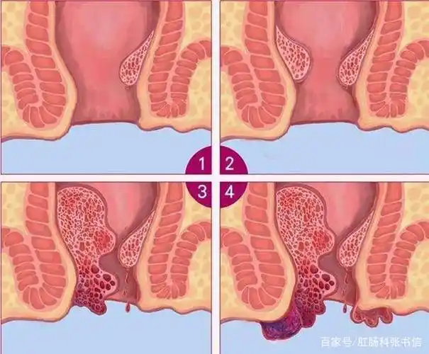 痔疮分4级,对号入座,看看你属于哪一级?
