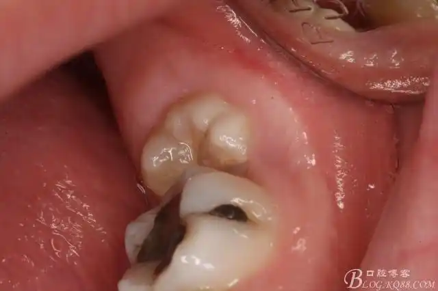 拔除双侧阻生下颌第二磨牙