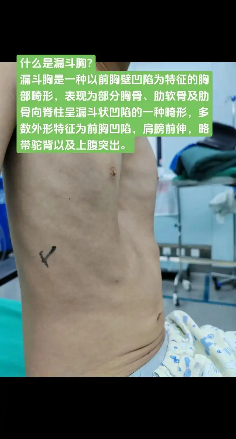 肋软骨及肋骨向脊柱呈漏斗状凹陷的一种畸形,多数外形特征为前胸凹陷