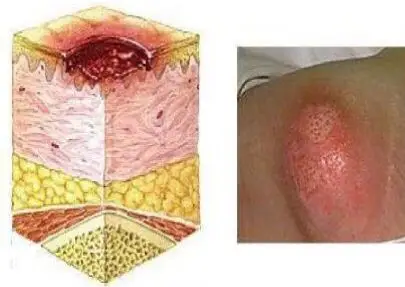 携手助力 远离压疮-第八个世界压疮预防日义诊活动