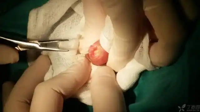 某厂生产的一次性包皮环切缝合器,以前见过视频介绍,正好有个严重包茎