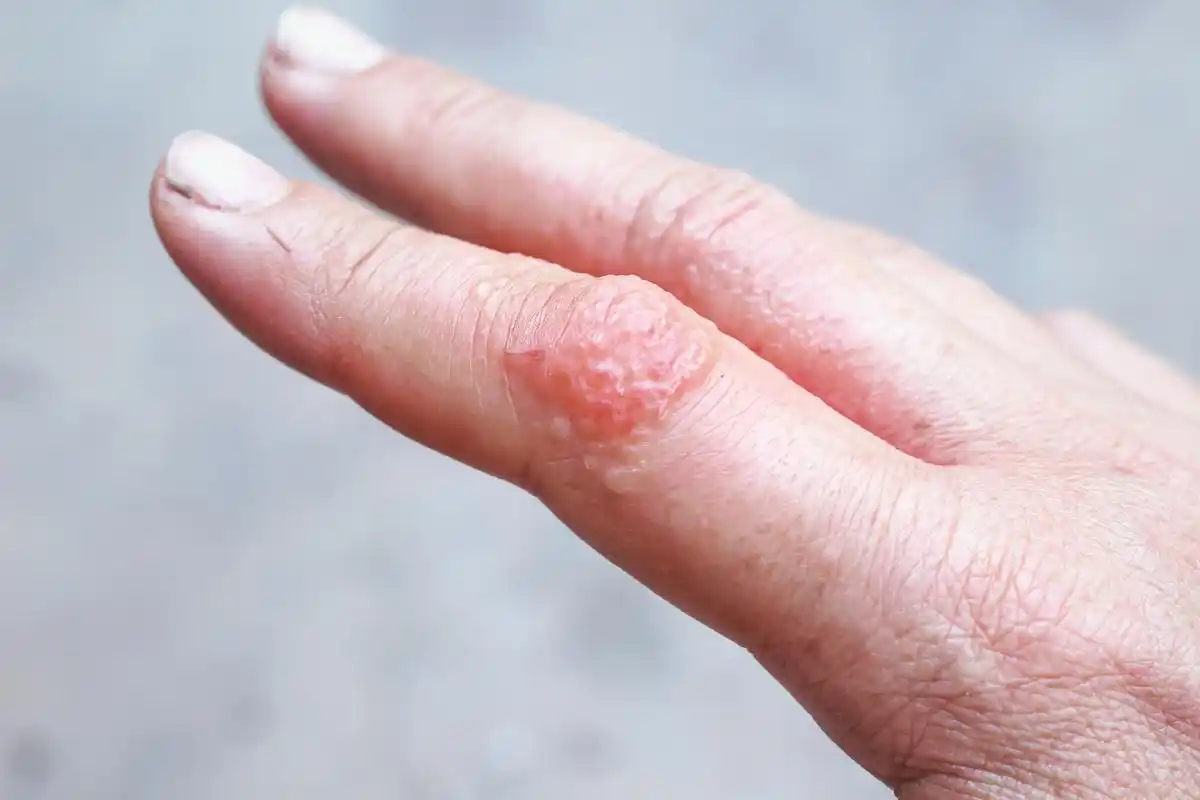 过敏性皮炎有哪些症状?  过敏性皮炎,又称为湿疹,是一种常见的皮肤病.