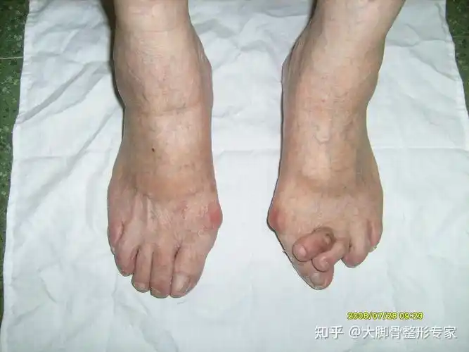 太吓人,这里就不发了因为她前些时间找我做过大脚骨手术,透过老人家