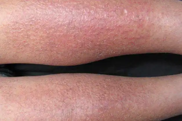 脚部湿疹初期症状图片