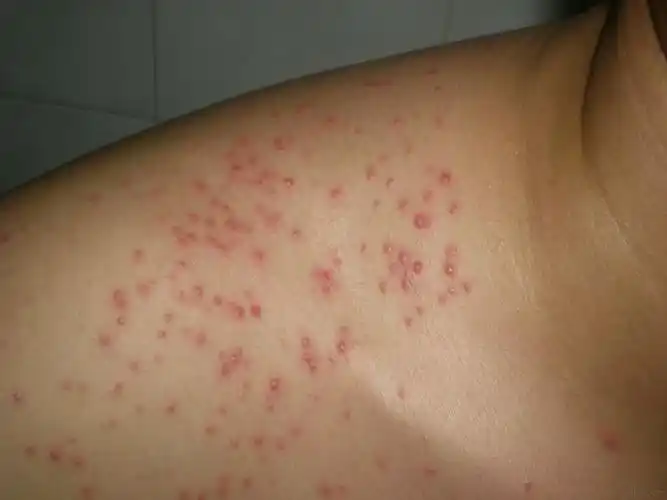 马拉色菌毛囊炎1例