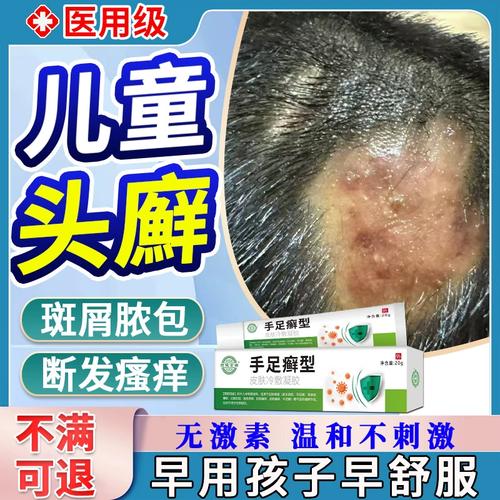 头皮藓药膏真菌感染儿童头皮有疙瘩毛囊炎断发脓包红斑头痒om