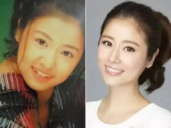 地包天小下巴面部倾斜别让牙齿畸形毁了孩子的颜值