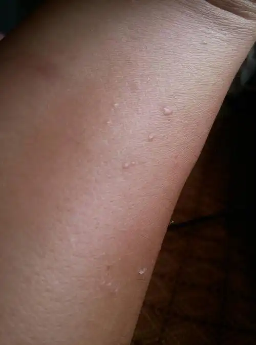 答: 根据你说的症状主要是免疫力低下,病毒引起扁平疣表现,治疗应该抗