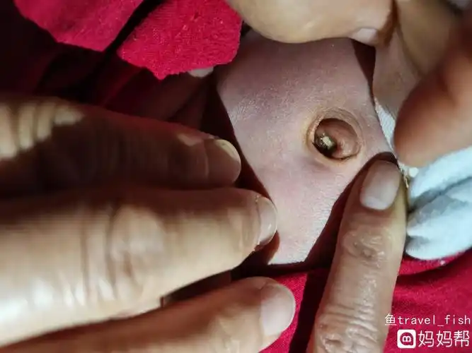 肚脐眼_虐肚脐文章钻肚脐吧_肚脐炎和肚脐湿疹区别