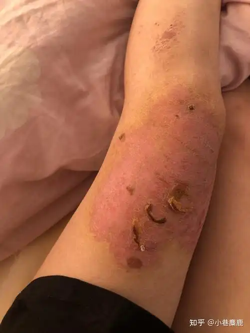 腿部被开水烫伤的恢复记录