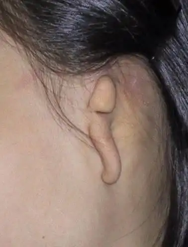 小耳畸形等级分类图片详解