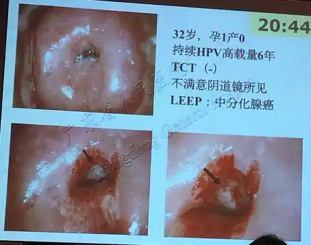 宫颈腺癌早期诊断不容忽视