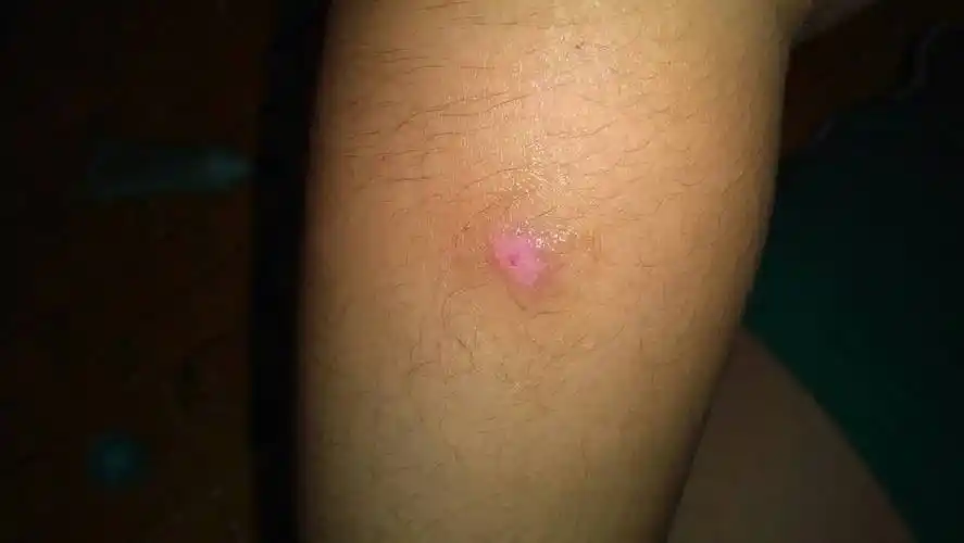 结痂被自己扣掉了,怎么办,饮食注意什么,我是立刻抹上了完美芦荟胶,还