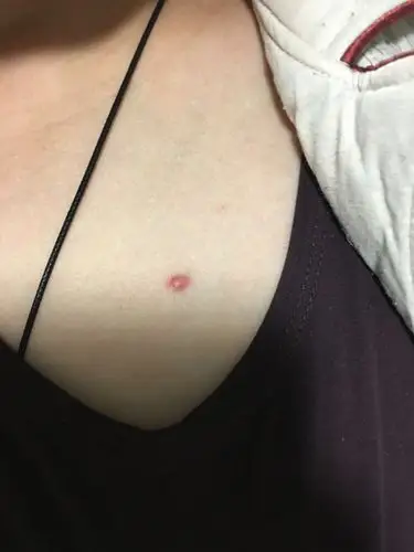 我是男生今年夏天出汗运动后胸口出现一个小红包一开始不疼