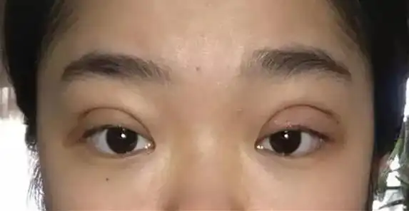 双眼皮过宽,瞬间老十岁!