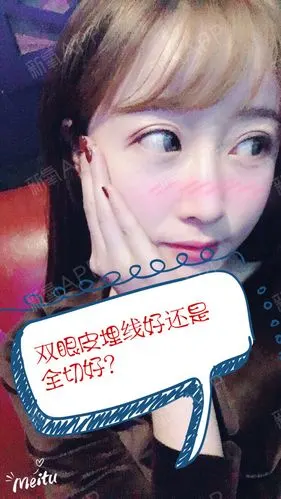 全切双眼皮vs埋线双眼皮