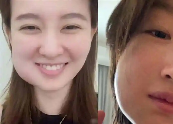 智齿不拔有什么危害我的智齿拔了脸型变了