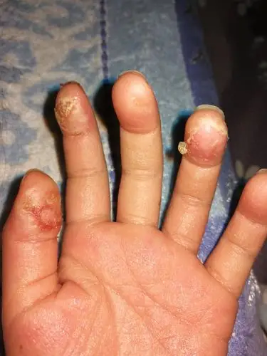 六岁孩子手指肚肿胀破皮,怎么办?