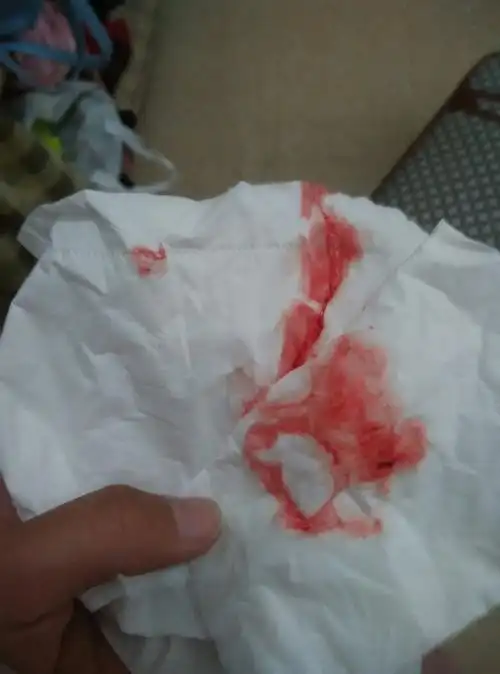 我是6号走的月经,十号那天白带里带些血丝,今天又流血了,流的是血,这