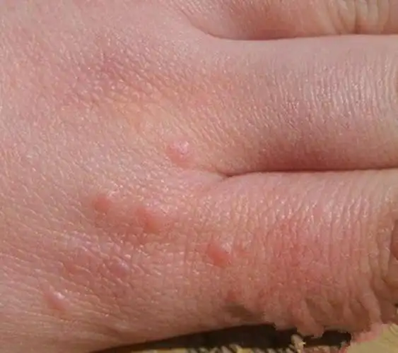 假尖锐湿疣白醋测试图片_有来医生