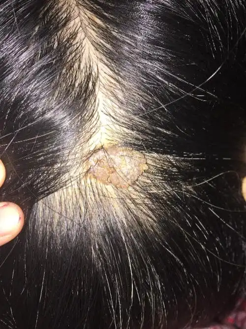 女,八十岁 头发中心有一个硬壳的痂,不痛不痒,想知道是什么东西?