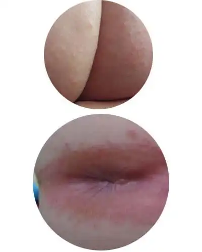 婴儿屁屁上的长了湿疹,那个牌的护臀膏管用啊?