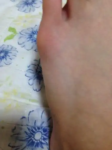 为什么小拇指旁边多处一块骨头.疼.别扭