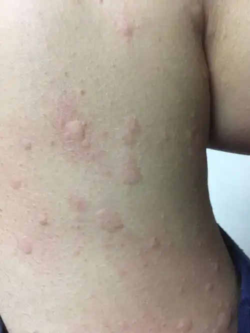 身上起了很多这种包,是跳蚤咬的还是皮肤过敏?