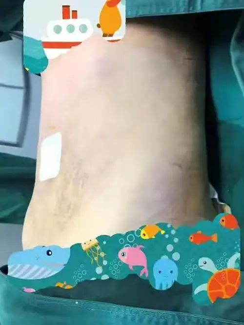 几年前做过一次腰腹吸脂,搞得腰腹凹凸不平,一直想着_圈子-新氧美容