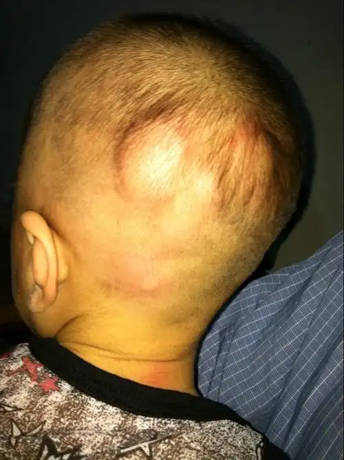 11个月的宝宝头上莫名起了很多大包包