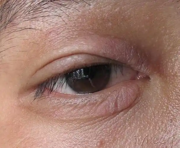 眼周皮疹三年 - 皮肤及性传播疾病讨论版 - 爱爱医医学论坛