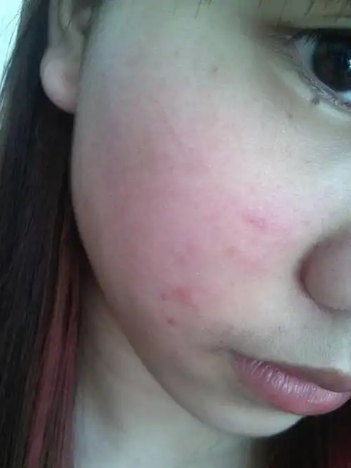 最近脸上总是反复发红,发痒,浮肿,长痘.这是怎么了?以前从来不会的.