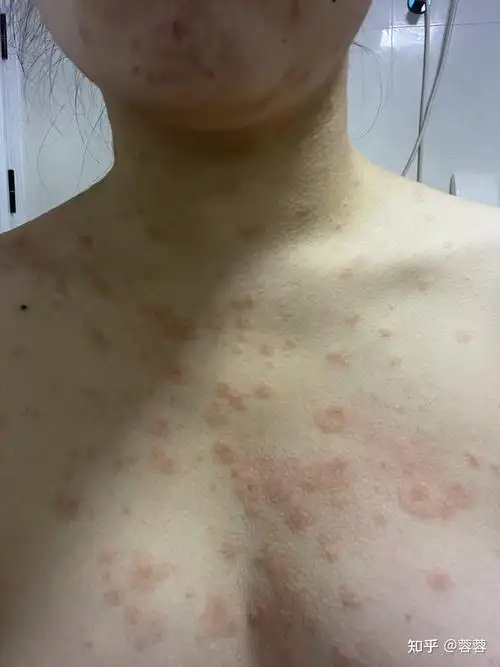 分享一下玫瑰糠疹的治疗过程