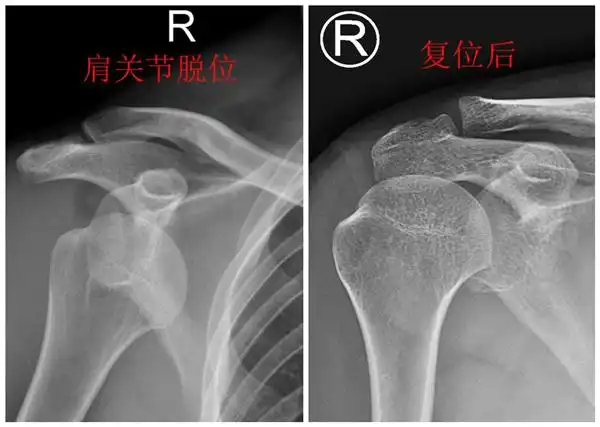 女子3年内肩关节脱位20多次医生取自体髂骨为其根治