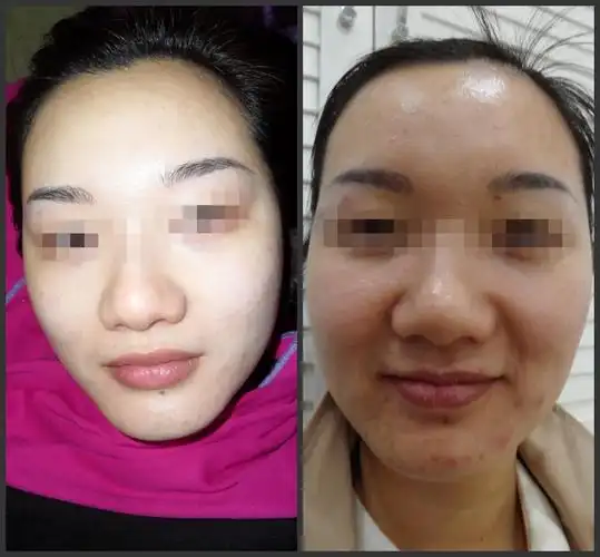 中医祛痘 中草药帮你祛除痘痘